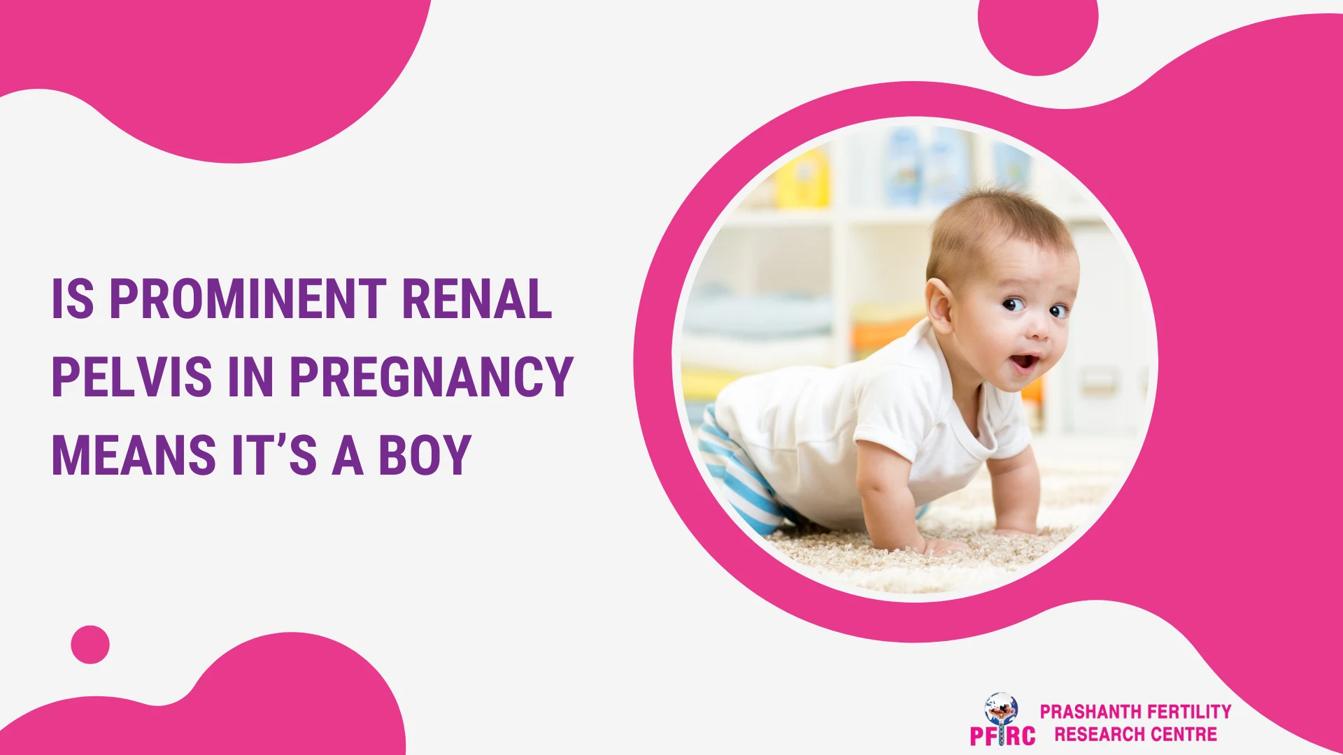 is prominent renal pelvis in pregnancy means its a boy