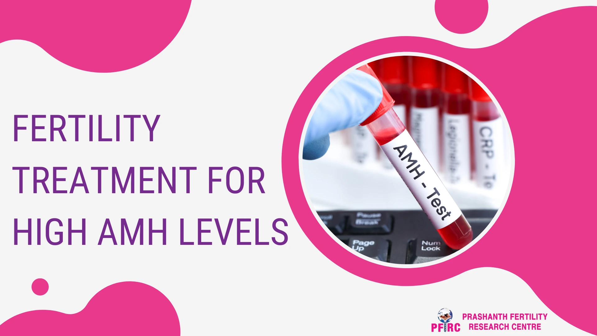 Fertility Treatment For High AMH Levels